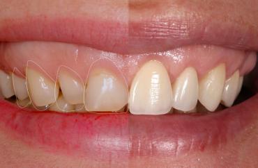 Эстетическая реставрация зубов