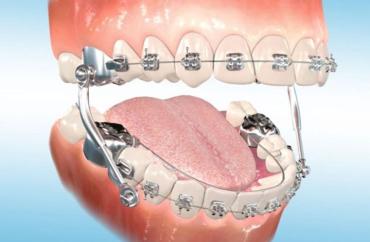 Исправления прикуса с помощью брекетов