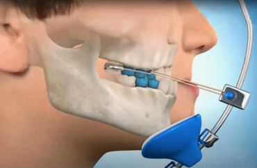 Функциональная терапия