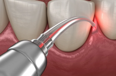 Лазерная терапия дёсен