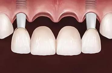 Имплантация передних зубов