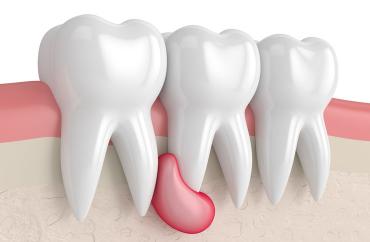 Киста зуба - лечение и удаление