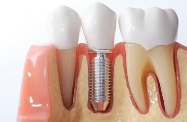 Имплантация 1 зуба