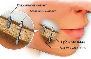 Базальная имплантация зубов
