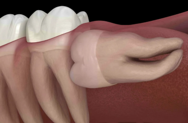 Удаление дистопированного зуба