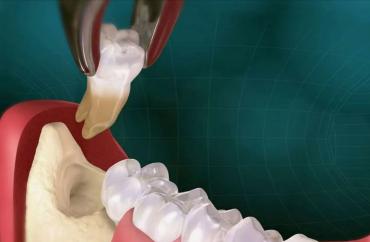 Удаление зубов мудрости