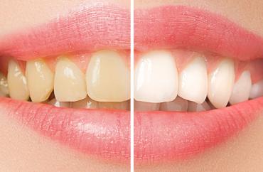 Отбеливание зубов