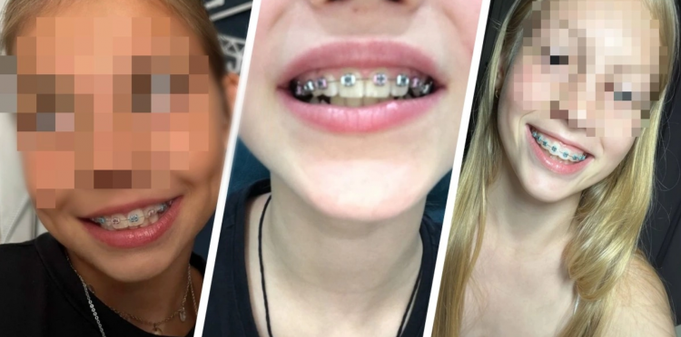 Подростки начали массово скупать фейковые брекеты